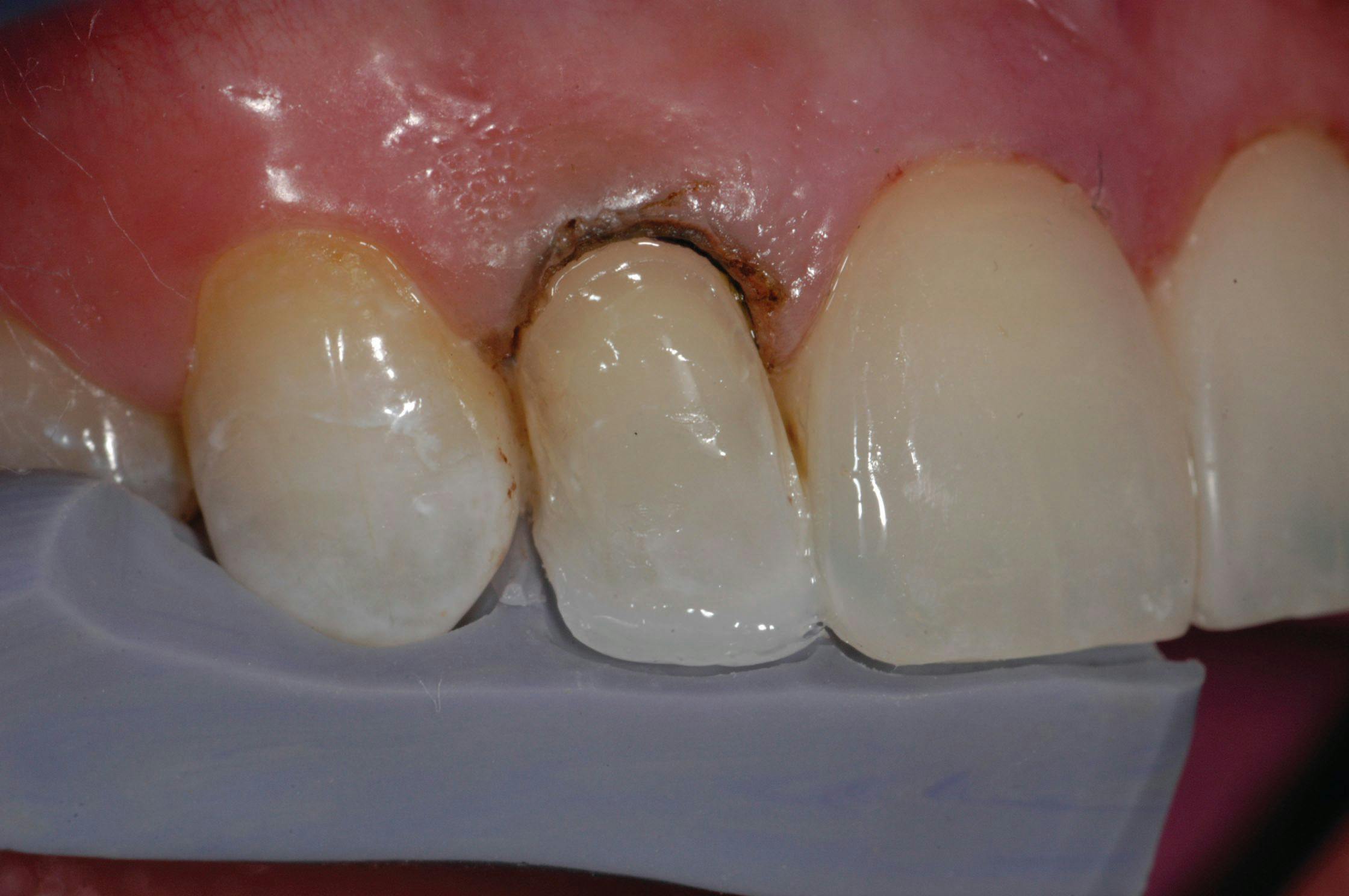 How to create conservative smile rejuvenation on a patient with peg laterals
