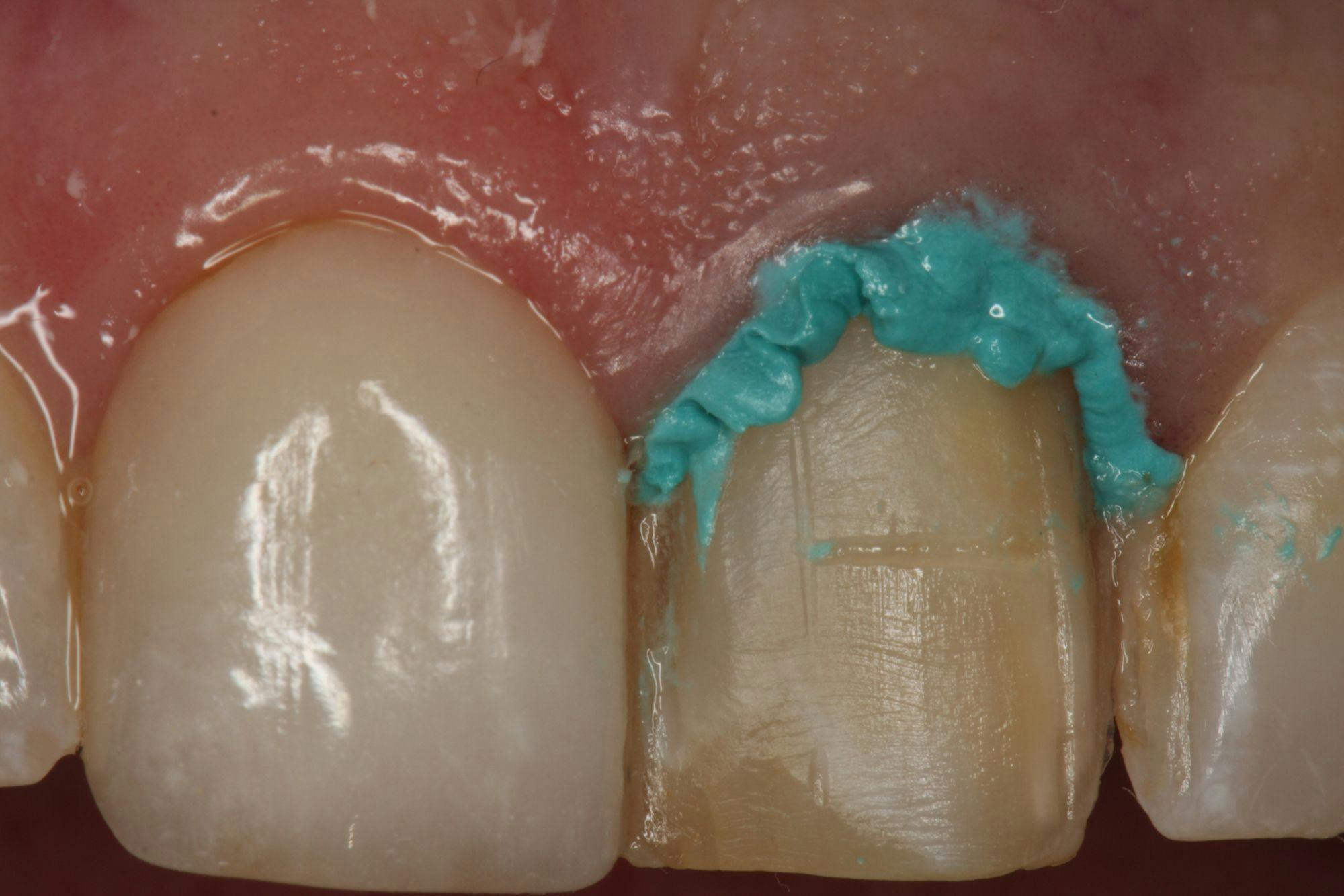 Figure 3. Retraction paste is used to control the gingival irritation caused by temporary restoration.