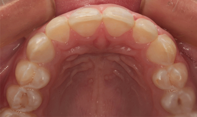Incisal view of prepared teeth