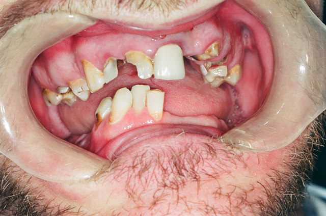 Meth mouth