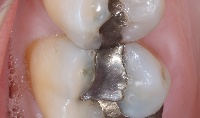 Making the transition to mercury-free dentistry