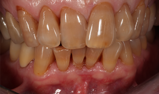 Preoperative close-up retracted view emphasizing crowding and tetracycline staining