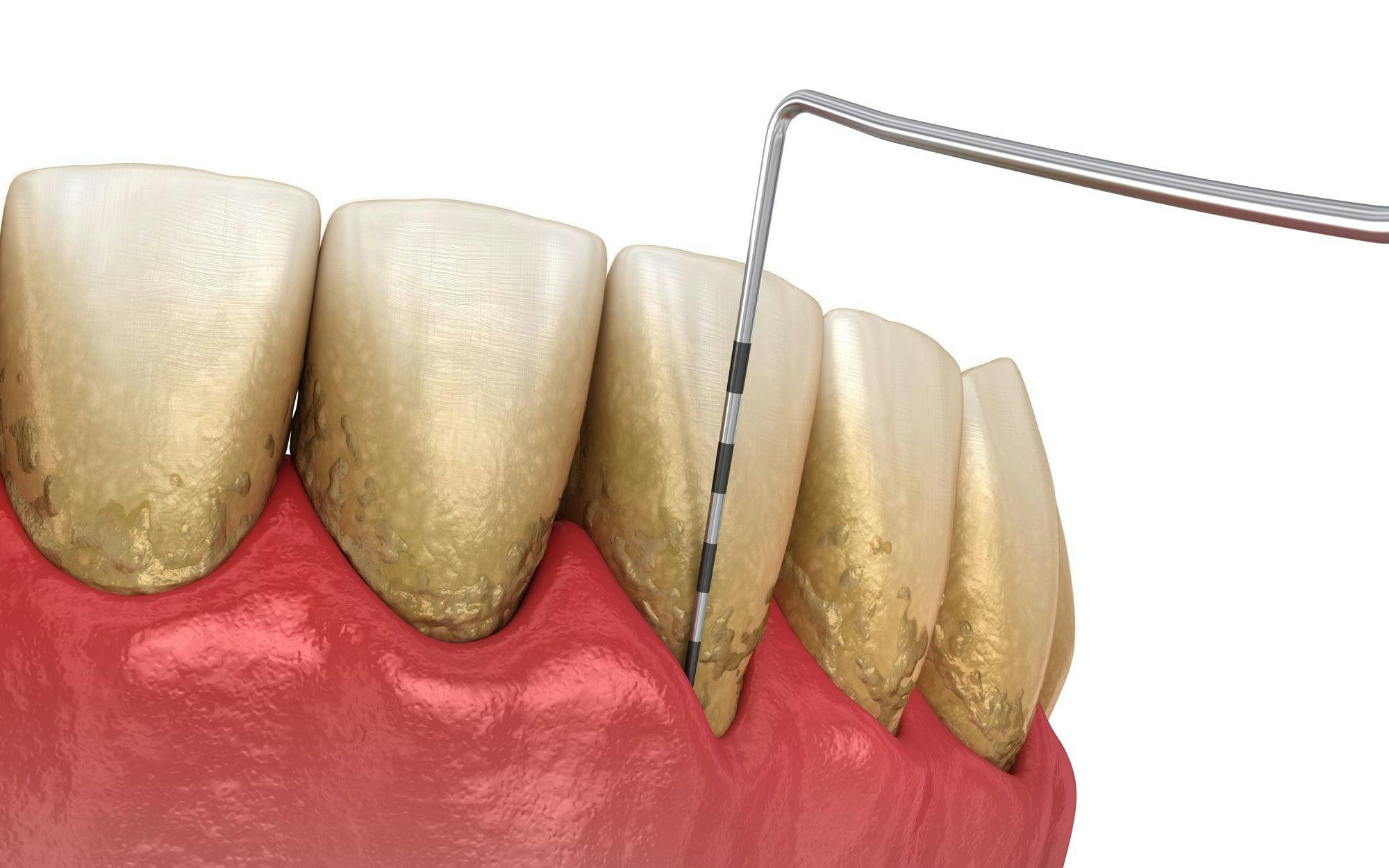 Periodontitis is Not Diagnosed by Probing Depths Alone. Photo courtesy of Alex Mit/stock.adobe.com. 