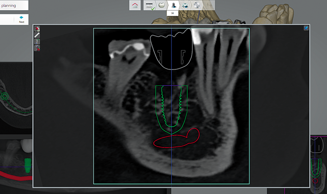 Designed crown in the CBCT scan