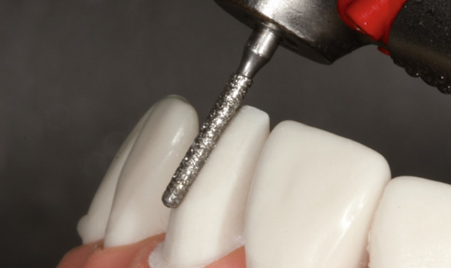 How to prep for all-ceramic anterior crowns with Expert Kit 4573ST