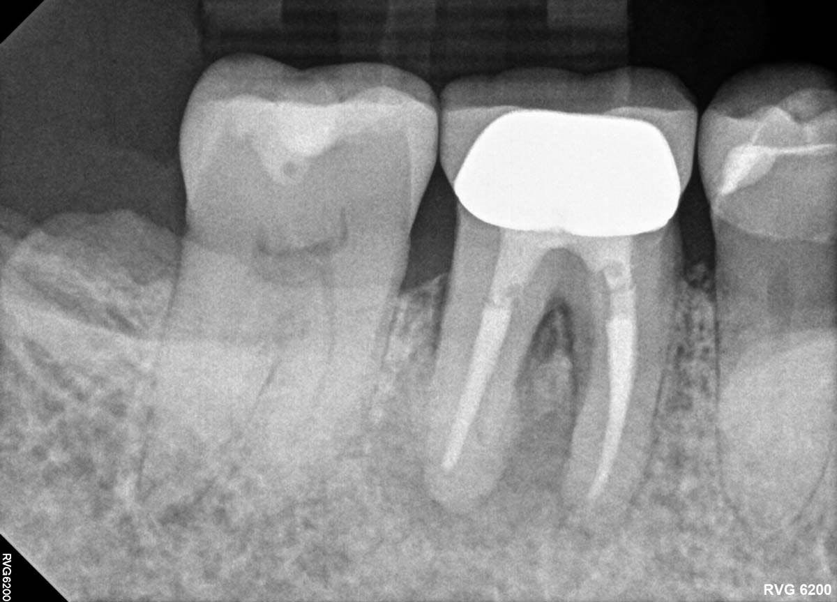 CBCT imaging in dentisry