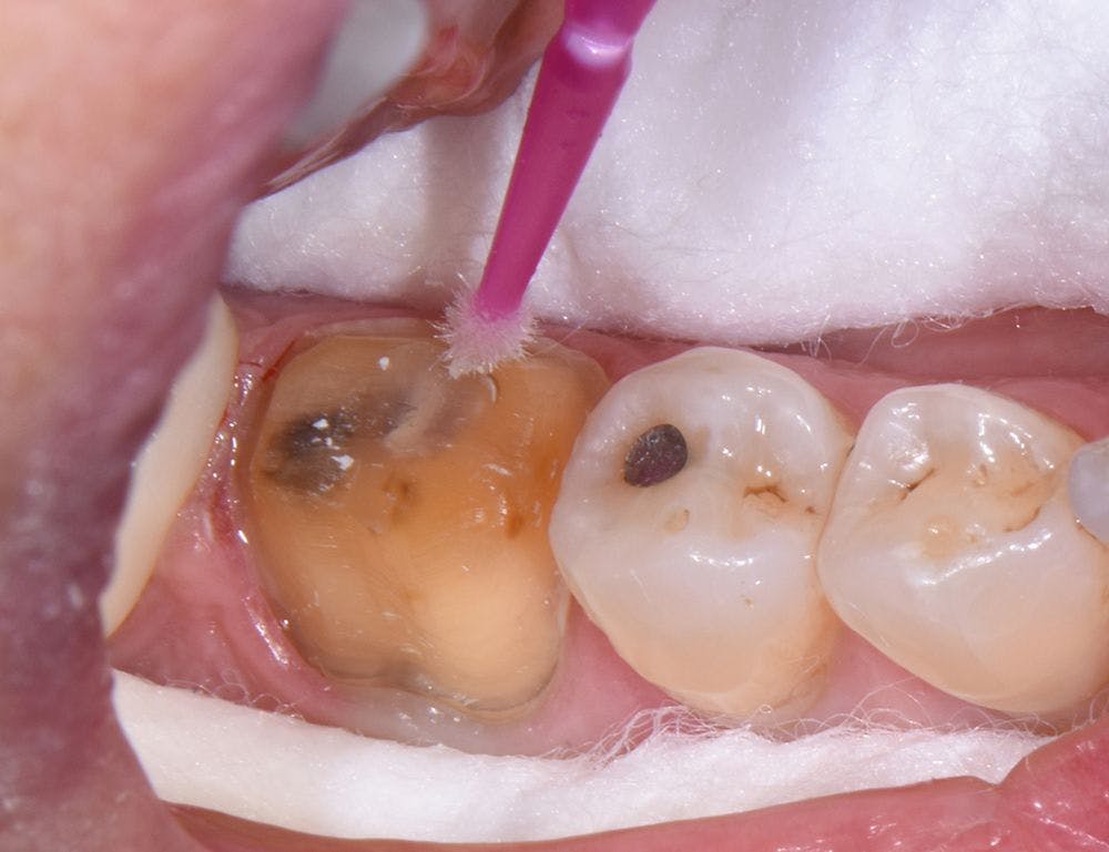Hemaseal & Cide being applied to a tooth.