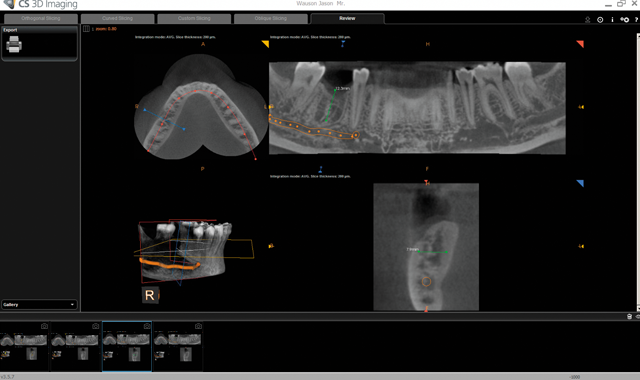 Virtual planning implant tooth # 30, using CS 3D imaging software