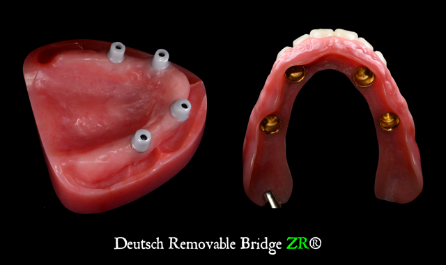 Deutsch Dental Arts, LLC releases Deutsch Removable Bridge ZR