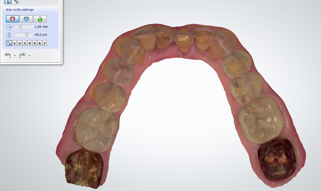 Preoperative facial view of the mandibular arch digital scan