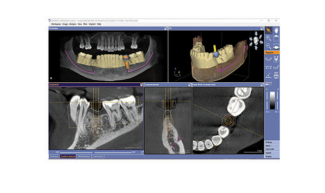 A complete approach to implant planning