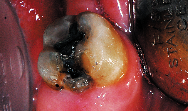 Patient presented with fractured amalgam on the mandibular left second molar.
