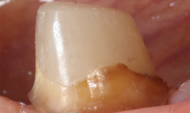 How to use a novel glass fiber post system for tricky restorations