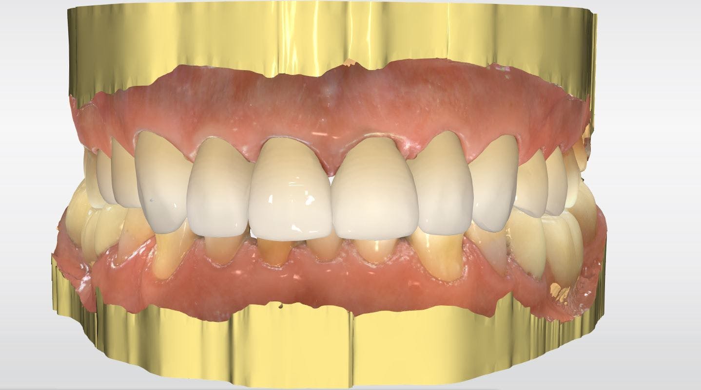 How to Rehabilitate a Maxillary Arch Using a Digital Workflow for Same-Day Smile Transformation