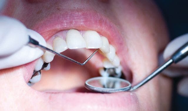 Study finds protein can inhibit bone loss from periodontitis