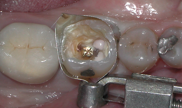 Fig 3. Occlusal view of tooth #30 with Tofflemire-type retainer