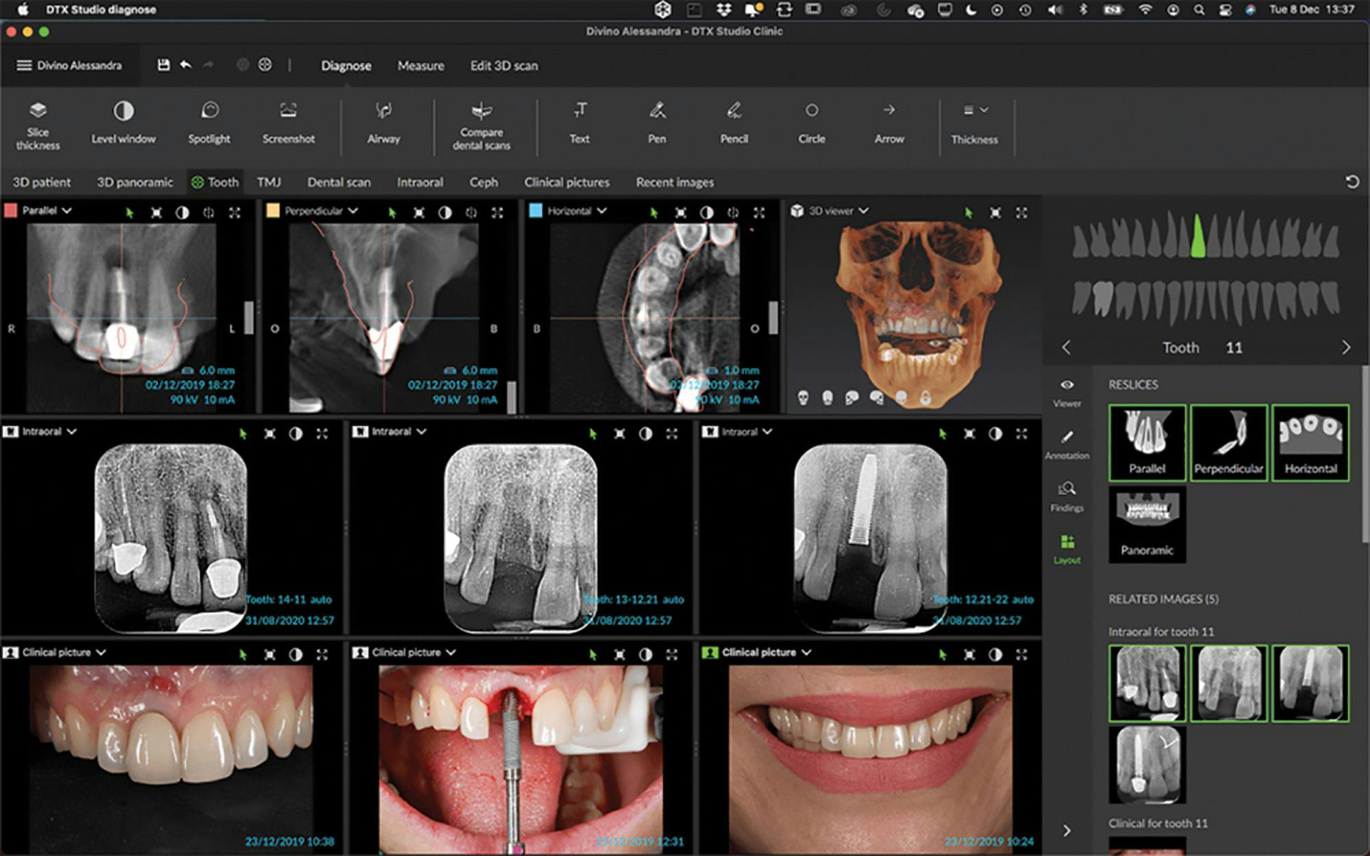 DTX Studio Clinic is the ultimate dental imaging software that keeps 2D and 3D imaging data together. With a simplified scanning process that can be implemented in all of a DSO’s practices, communicating specific scans and cases, such as implants or restorations, to the lab has been made that easier and more efficient across the board.