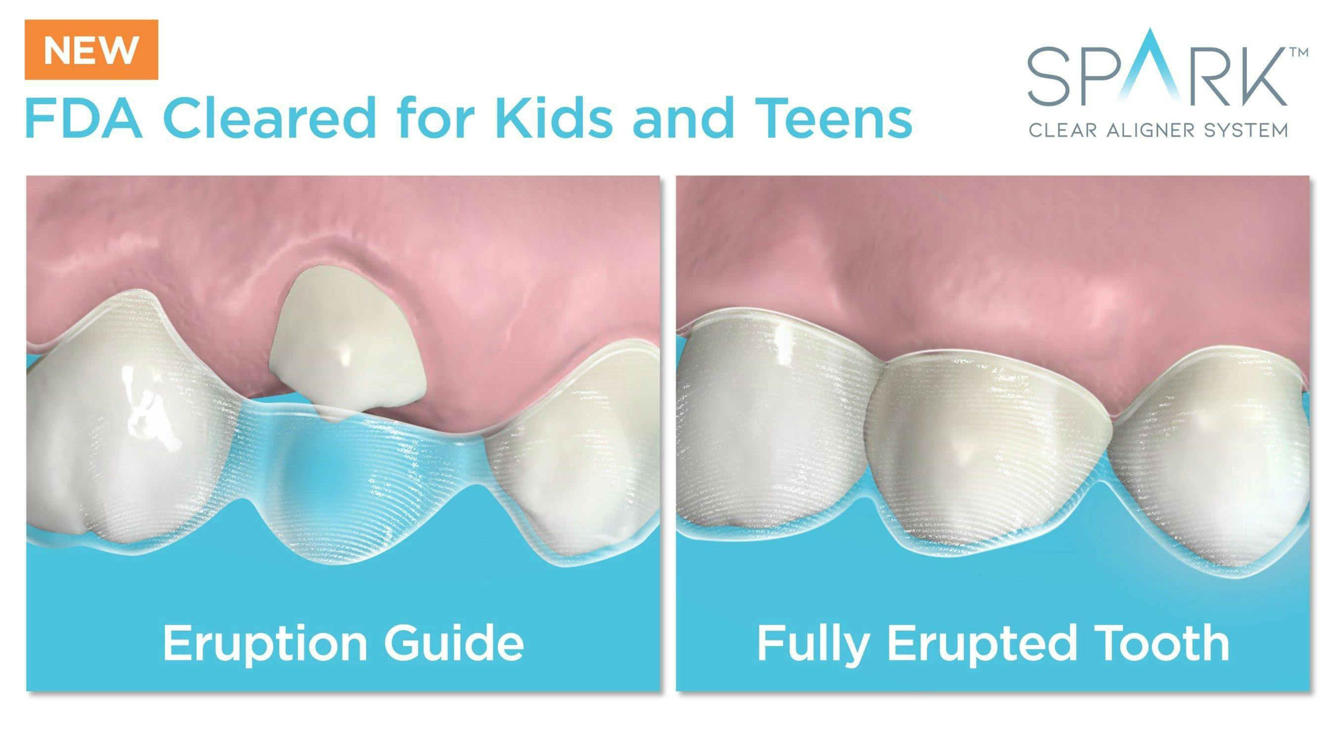 Spark Clear Aligner System Receives FDA Clearance for Younger Patients