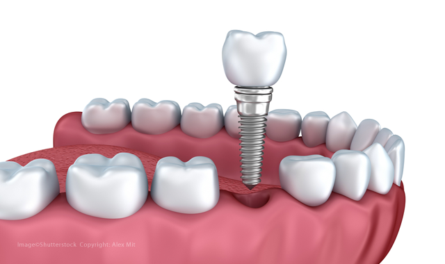 New coating could make dental implants better than ever