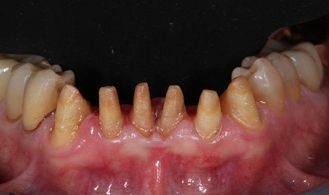 Retracted view of the mandibular preparations prior to temporization