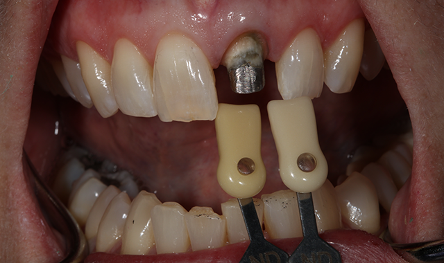 How to use GC Fuji PLUS for seating an anterior full-coverage zirconia crown restoration