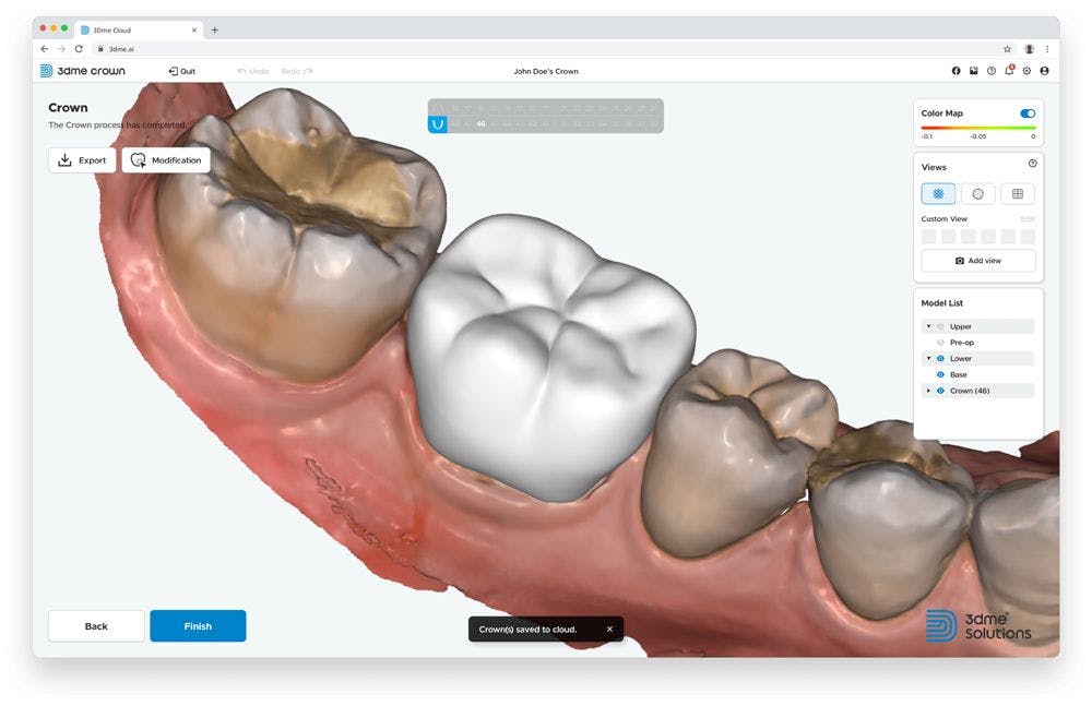 New AI-Based Web Dental CAD Designed to Offer One-Click Crown Design