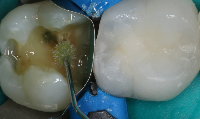 How to create more esthetic restorations