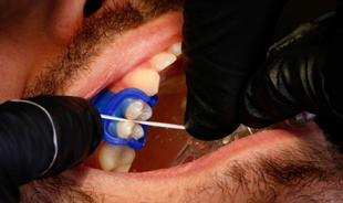 Flossing a dental restoration