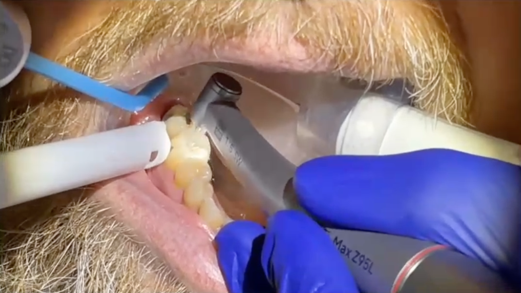Evading the Downsides of Practicing Dentistry – Products, Materials & techniques to Make Everyday Dentistry Enjoyable & Rewarding