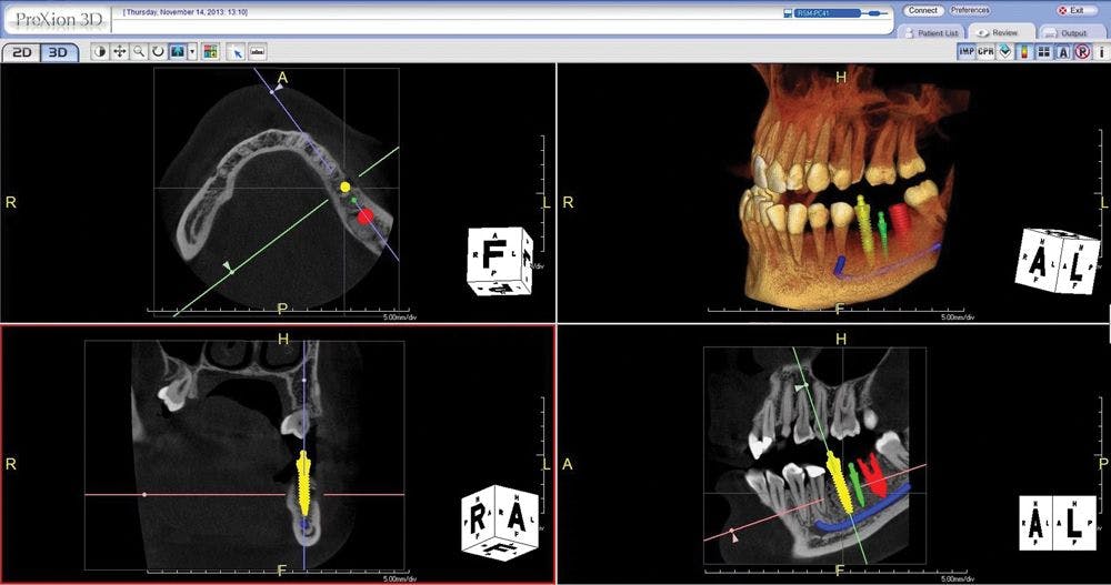 PreXion3D Excelsior PRO Test Drive software for implant treatment planning