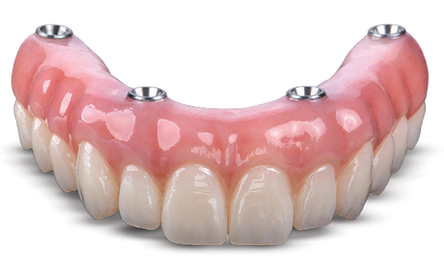 Solve My Problem: A great-looking dental implant prosthesis with plenty of strength