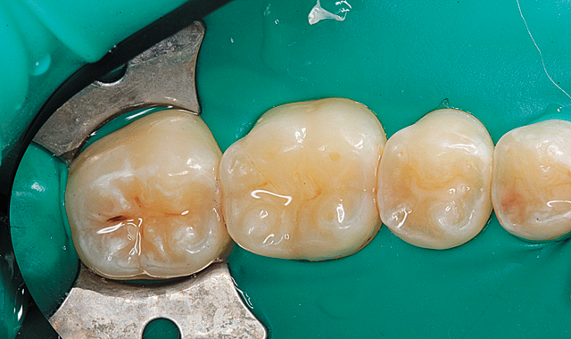 Image of teeth isolated with a rubber dam.