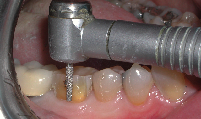 How to master single-unit crown procedures