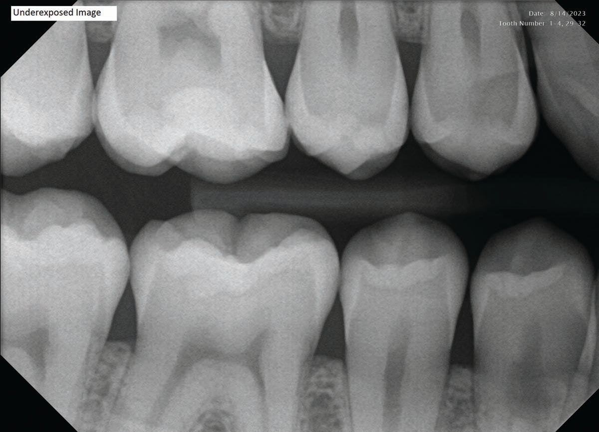 Underexposure. X-rays that are underexposed will look too light and grainy. These images cannot be properly fixed within the imaging software so it’s key to initially capture sharp images. | Image Credit: © DentiMax