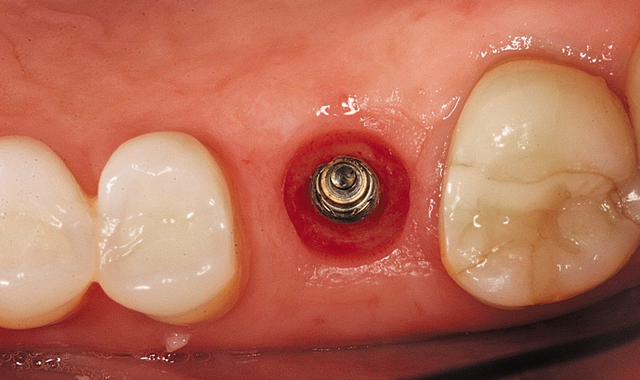 Implant site cleaned
