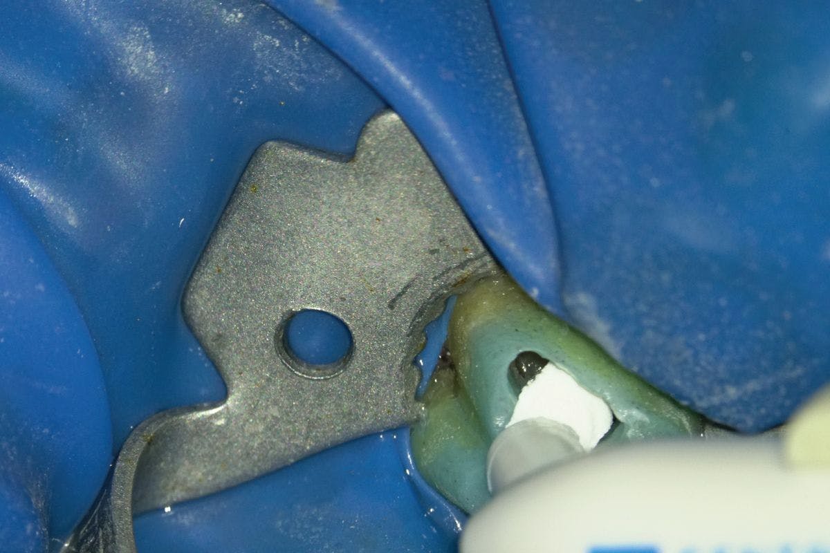 Figure 4. Tempit temporary material filling and sealing the access opening after placement of calcium hydroxide. 