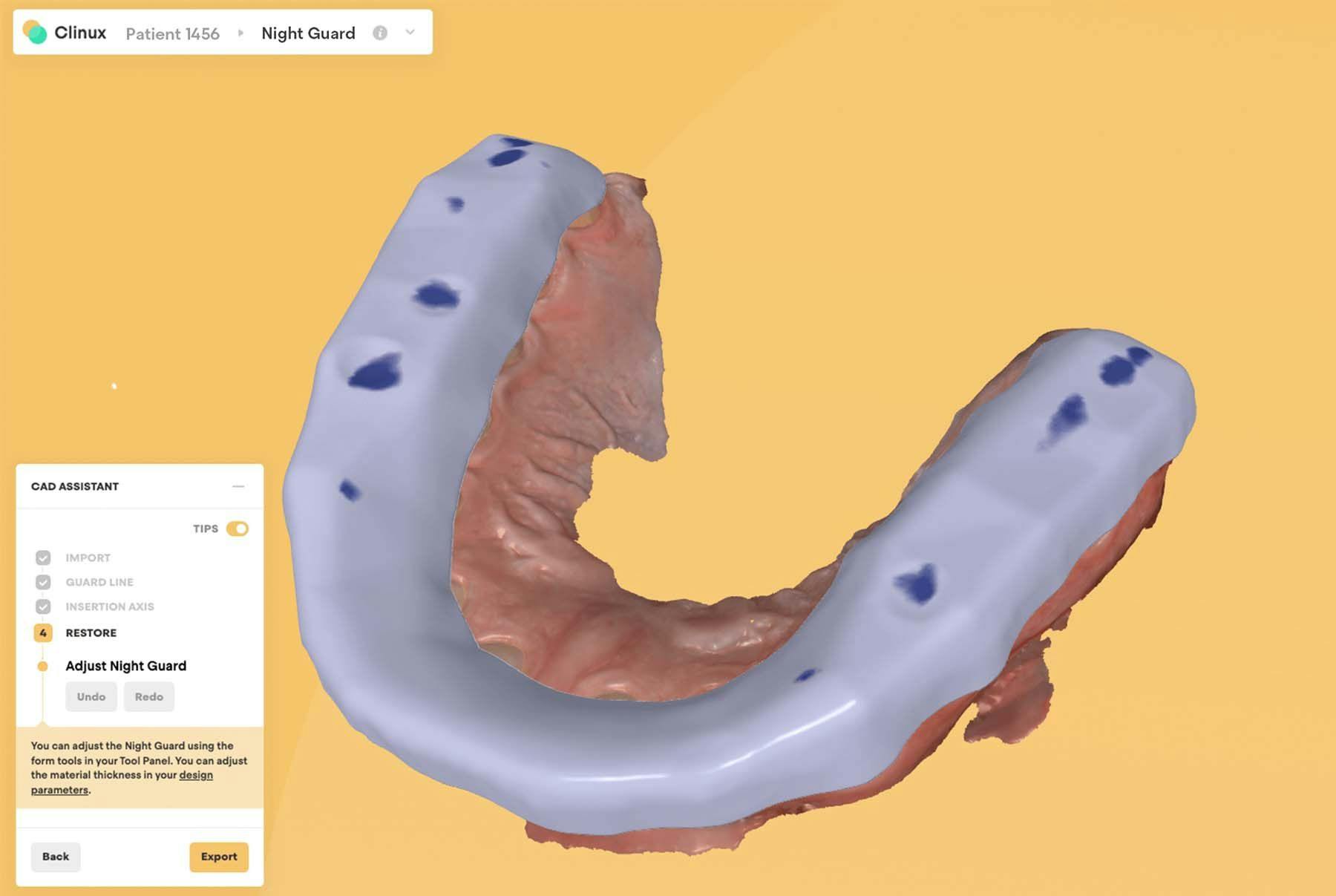 Clinux CAD's open system allows dentists to quickly fabricate inlays, onlays, crowns, crownlays, and night guards/splints within the browser. | Image Credit: © Clinux