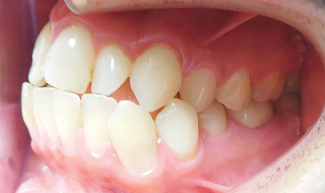How to increase predictability for faster tooth movement