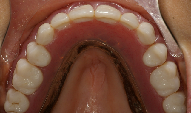 How to Simplify Overdenture Treatment for Today’s Patients