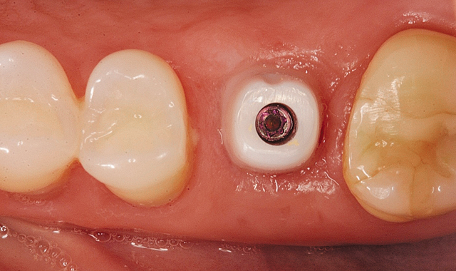 Zirconia oxide abutment in place