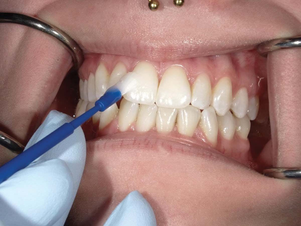A Comfortable, Patient-Friendly Way to Deal With the Gray Areas. Image courtesy of Ankur Gupta, DDS.