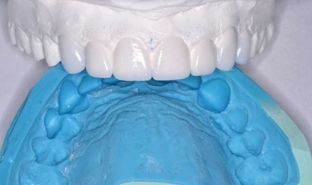 How to complete a smile design case with ACTIVA BioACTIVE-RESTORATIVE