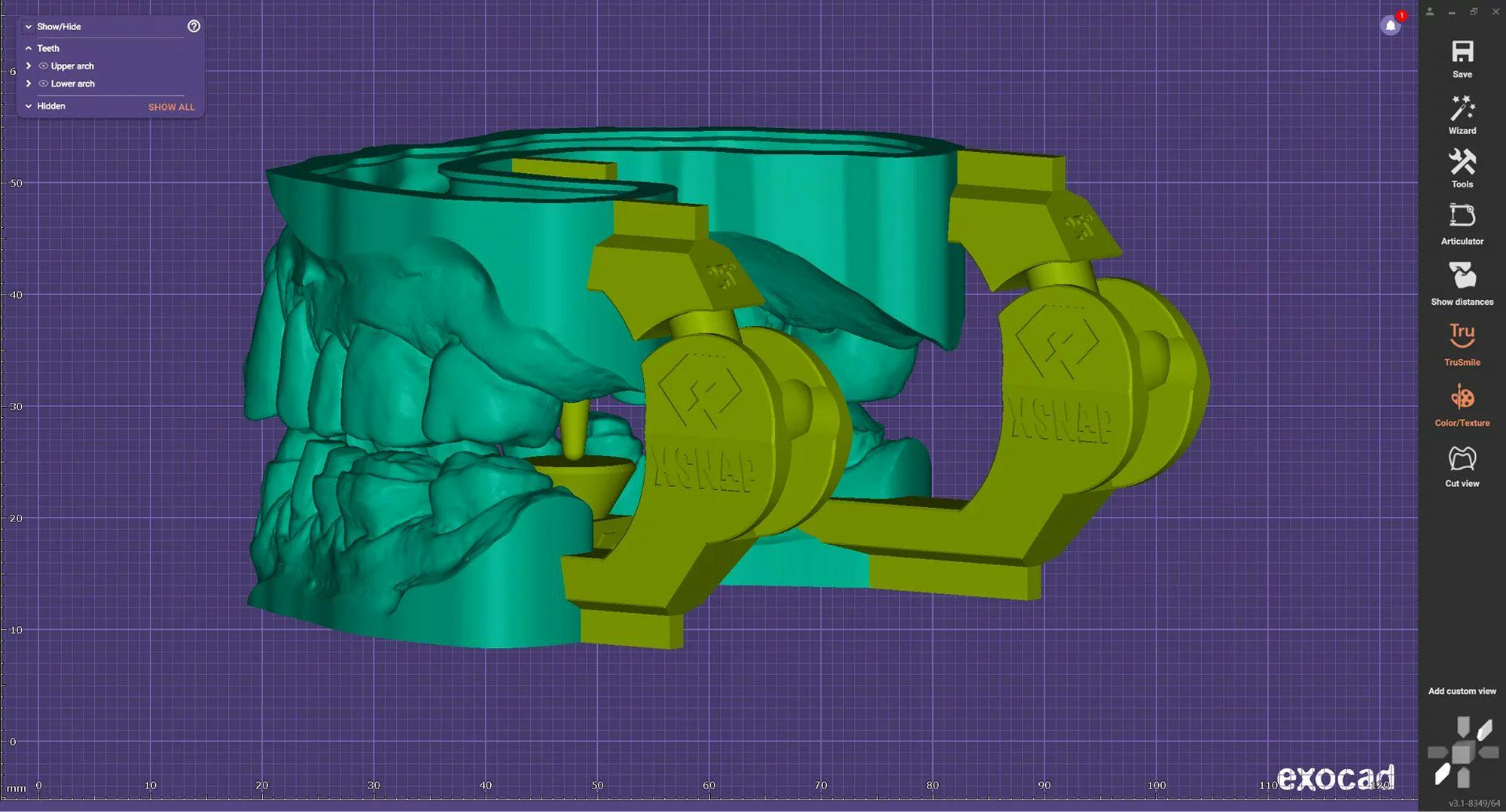 Exocad Adds xSNAP Add-On Module to for DentalCAD 3.1 Rijeka for Mandibular Simulation