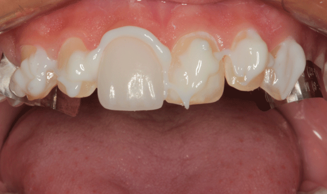 Self-adhesive resin cement applied directly to teeth and first veneer placed