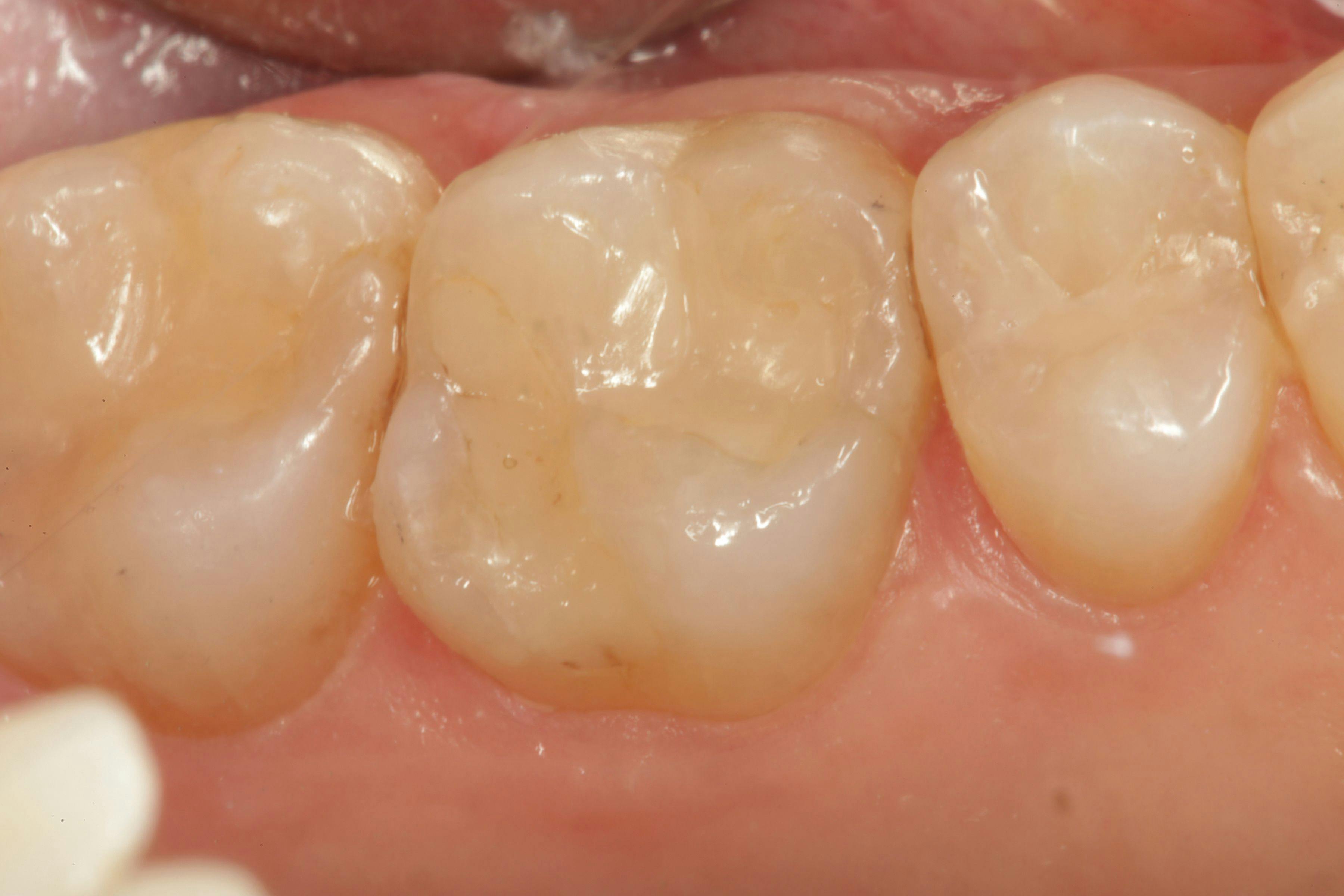 Occlusal view of the completed restoration after placing Activa Presto as the enamel layer