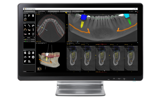 Using the Prosthetic-Driven Implant Planning Module from Carestream Dental