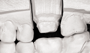 Fig. 7 Occlusal clearance of dental restoration