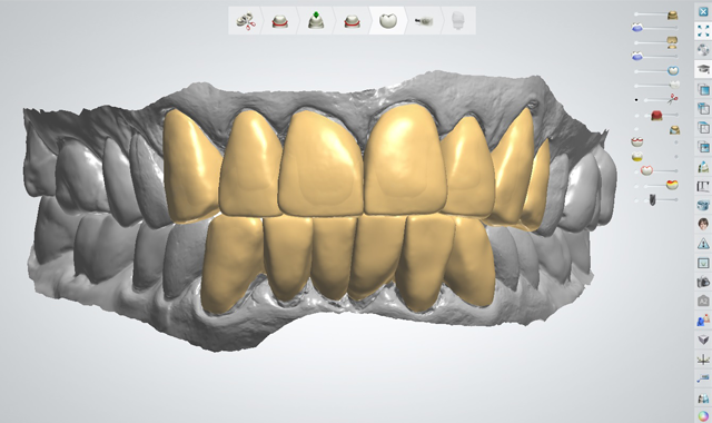 3Shape CAD software was used to virtually alter the patientâs existing dentition and create a digital diagnostic wax-up of the proposed restorations
