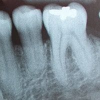 Study Suggests Nanoparticles Could Prevent Tooth Decay