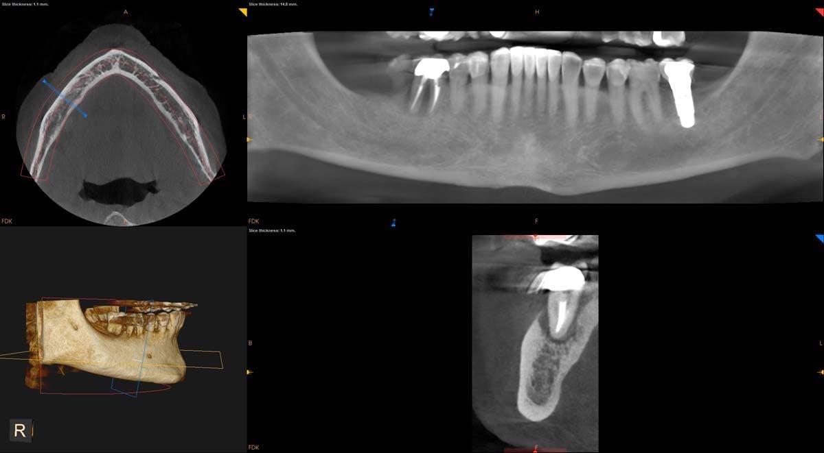 Use CBCT  to Educate Patients to Make Informed Treatment Decisions  